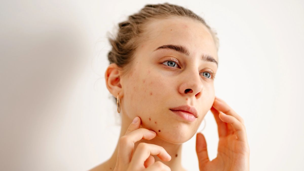 Slunce pleť nelepší, to je mýtus. Opalovací krém patří i na akné, říká lékařka